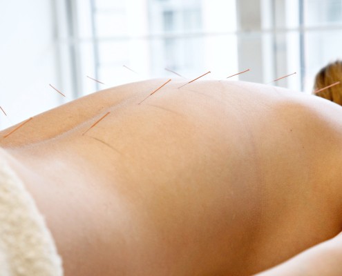 Kvinne som ligger på magen med akupunkturnåler i ryggen